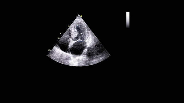 经食管超声下灰度型心脏影像学 — 图库照片