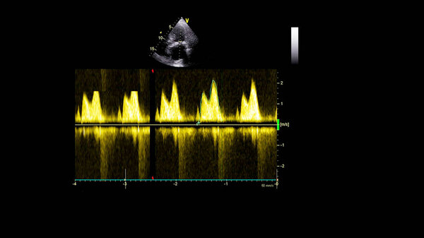 Изображение сердца в сером режиме во время трансофагеального ультразвука.