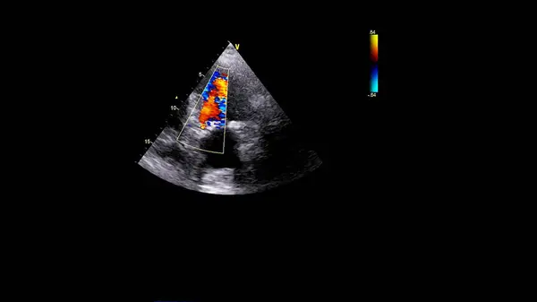 ドップラーモードで経食道超音波中の心臓の画像 — ストック写真