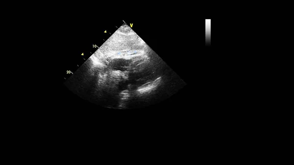 Image of the heart in gray-scale mode during transesophageal ultrasound.