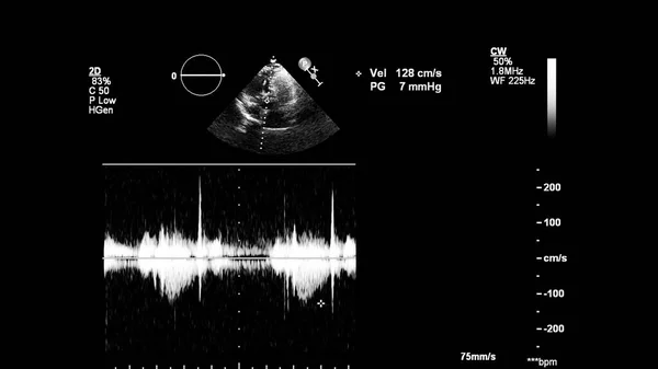 Gambar Jantung Dalam Mode Skala Abu Abu Selama Usg Transesophageal — Stok Foto