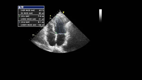 经食管超声下灰度型心脏影像学 — 图库照片