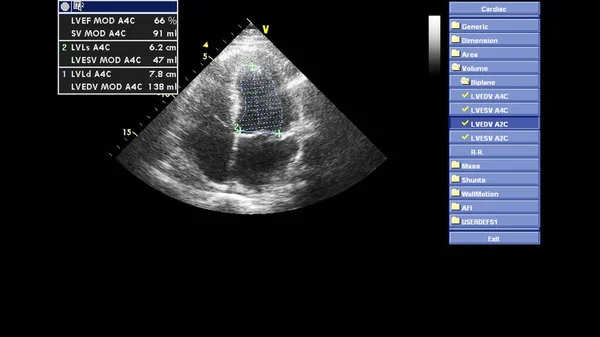 Transesofageal Ultrason Sırasında Kalbin Gri Ölçekli Görüntüsü — Stok fotoğraf