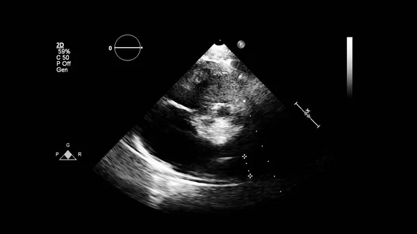 Image of the heart in gray-scale mode during transesophageal ultrasound.