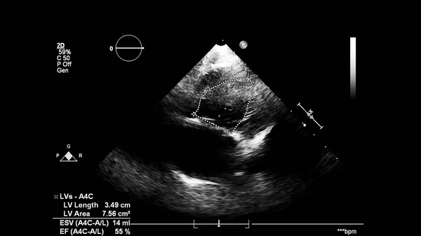 経食道超音波検査時のグレースケールモードで心臓の画像 — ストック写真