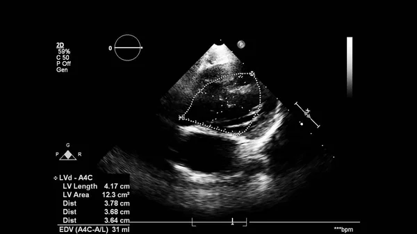 Afbeelding Van Het Hart Grijs Schaal Modus Tijdens Transesofageale Echografie — Stockfoto