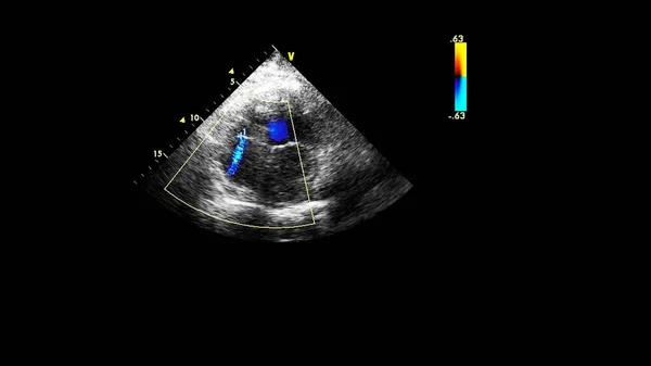 Image Cœur Lors Une Échographie Transœsophagienne Mode Doppler — Photo
