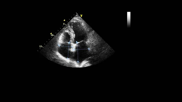 Kép Szív Szürke Skála Mód Során Transesophagealis Ultrahang — Stock Fotó