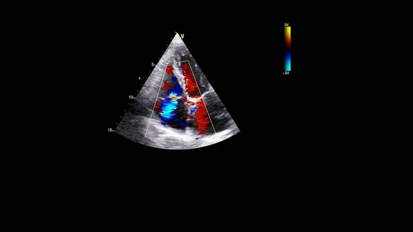 Imagem Coração Durante Ultrassom Transesofágico Com Modo Doppler — Fotografia de Stock