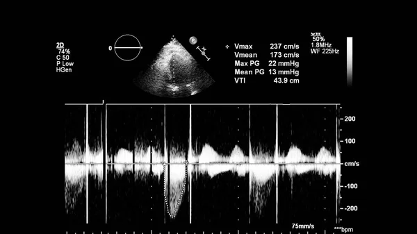 Transesofageal Ultrason Sırasında Kalbin Gri Ölçekli Görüntüsü — Stok fotoğraf