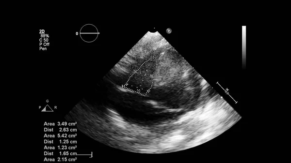 Изображение Сердца Сером Режиме Время Трансофагеального Ультразвука — стоковое фото