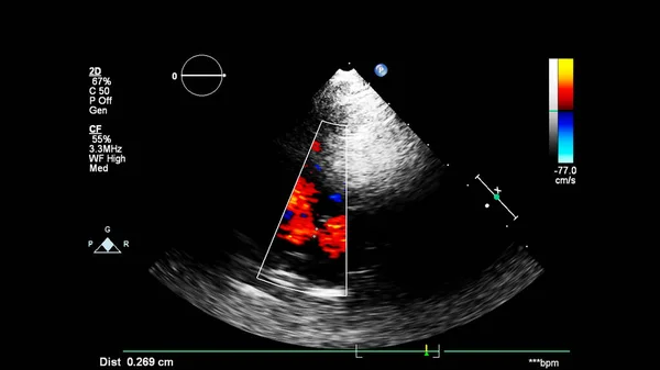 Bild Des Herzens Beim Transesophagealen Ultraschall Mit Doppler Modus — Stockfoto