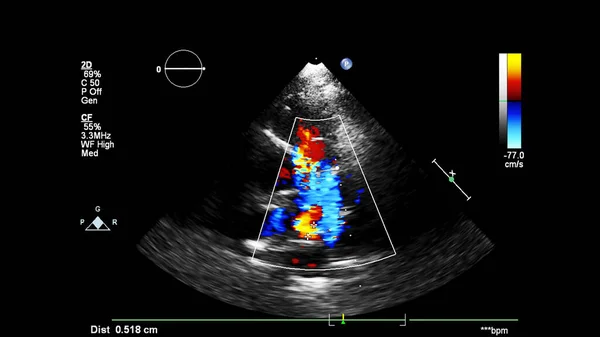 Image Cœur Lors Une Échographie Transœsophagienne Mode Doppler — Photo