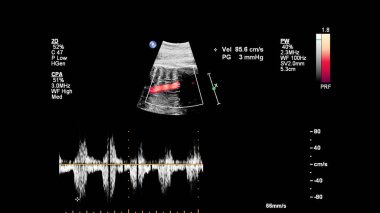 Fetal ekokardiyografi ile ultrasonografi ekranı
