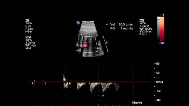 Fetal ekokardiyografi ile ultrasonografi ekranı