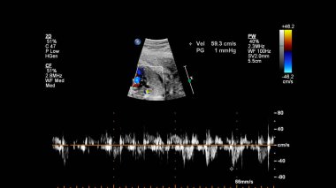 Fetal ekokardiyografi ile ultrasonografi ekranı