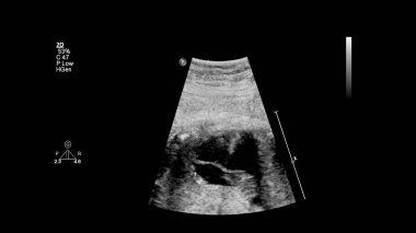 Fetal ekokardiyografi ile ultrasonografi ekranı