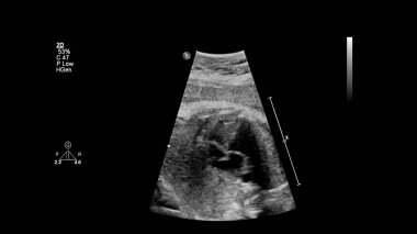 Fetal ekokardiyografi ile ultrasonografi ekranı