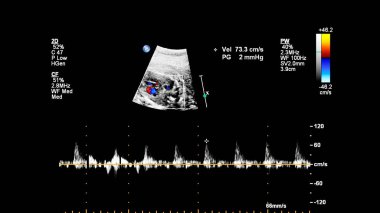Fetal ekokardiyografi ile ultrasonografi ekranı