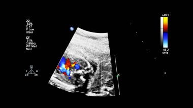 Fetal ekokardiyografi ile ultrasonografi ekranı