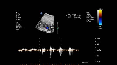Fetal ekokardiyografi ile ultrasonografi ekranı