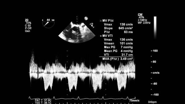 Изображение сердца в сером режиме во время трансофагеального ультразвука.