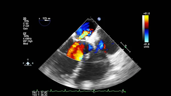 Beeld Van Het Hart Tijdens Transesofageale Echografie Met Doppler Modus — Stockfoto