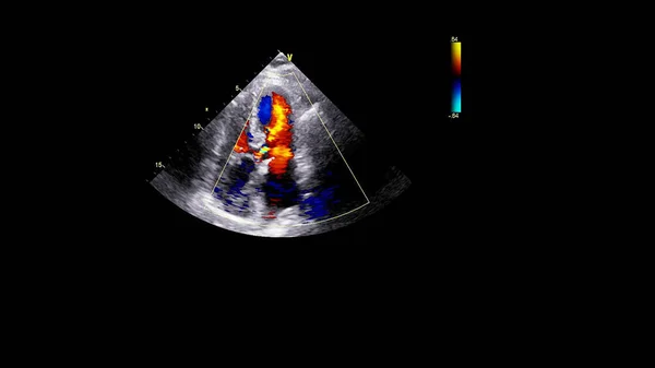 Εικόνα Της Καρδιάς Κατά Διάρκεια Των Υπερήχων Του Οισοφάγου Λειτουργία — Φωτογραφία Αρχείου