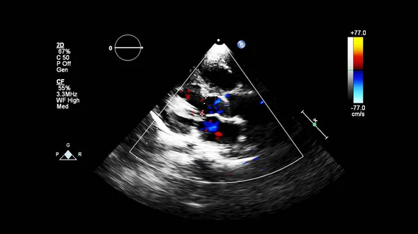 Obrázek Srdce Během Transesofageálního Ultrazvuku Dopplerovým Módem — Stock fotografie