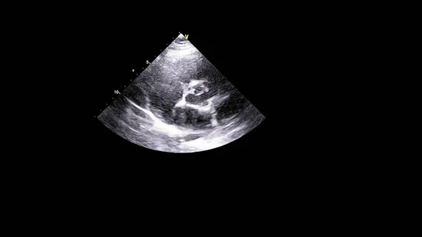 Image Heart Gray Scale Mode Transesophageal Ultrasound — Stock Photo, Image