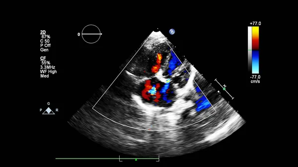 Immagine Del Cuore Durante Ecografia Transesofagea Con Modalità Doppler — Foto Stock