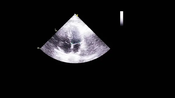 Transesofageal Ultrason Sırasında Kalbin Gri Ölçekli Görüntüsü — Stok fotoğraf