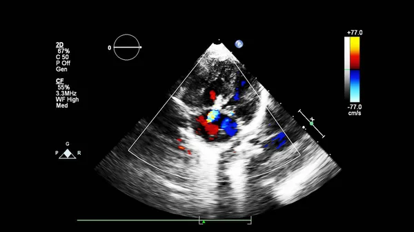 Imagem Coração Durante Ultrassom Transesofágico Com Modo Doppler — Fotografia de Stock