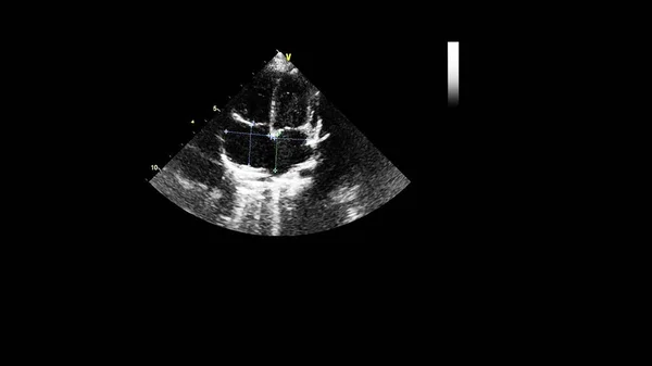 经食管超声下灰度型心脏影像学 — 图库照片