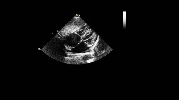 Image Heart Gray Scale Mode Transesophageal Ultrasound — Stock Photo, Image