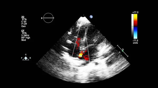 Immagine Del Cuore Durante Ecografia Transesofagea Con Modalità Doppler — Foto Stock