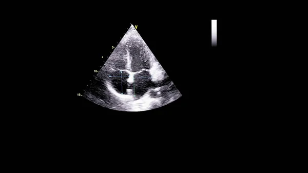 Afbeelding Van Het Hart Grijs Schaal Modus Tijdens Transesofageale Echografie — Stockfoto