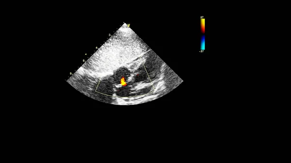 Зображення Серця Під Час Ультразвуку Доплерівським Режимом — стокове фото