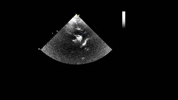 Kép Szív Szürke Skála Mód Során Transesophagealis Ultrahang — Stock Fotó