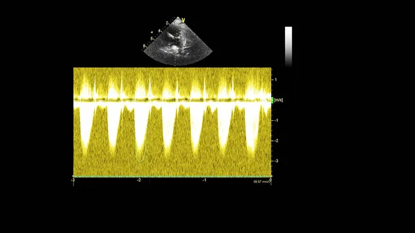 Transesofageal Ultrason Sırasında Kalbin Gri Ölçekli Görüntüsü — Stok fotoğraf