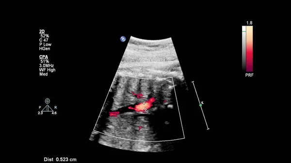 Ecrã Ultrassonográfico Com Ecocardiografia Fetal — Fotografia de Stock