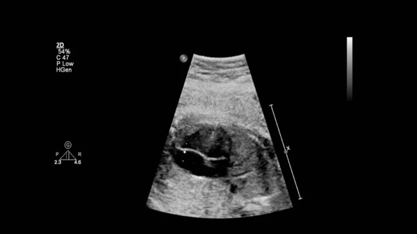 Ecrã Ultrassonográfico Com Ecocardiografia Fetal — Fotografia de Stock