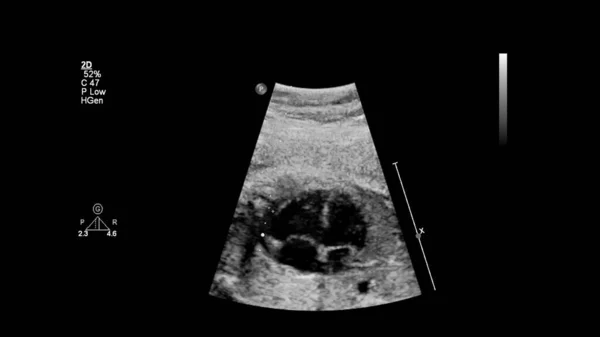 Ecrã Ultrassonográfico Com Ecocardiografia Fetal — Fotografia de Stock