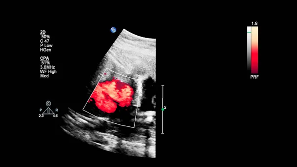 Ecrã Ultrassonográfico Com Ecocardiografia Fetal — Fotografia de Stock