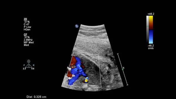 Fetal Ekokardiyografi Ile Ultrasonografi Ekranı — Stok fotoğraf