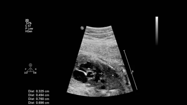 Ecrã Ultrassonográfico Com Ecocardiografia Fetal — Fotografia de Stock