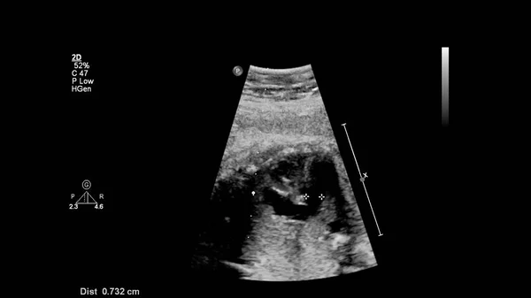 Echografie Scherm Met Foetale Echocardiografie — Stockfoto