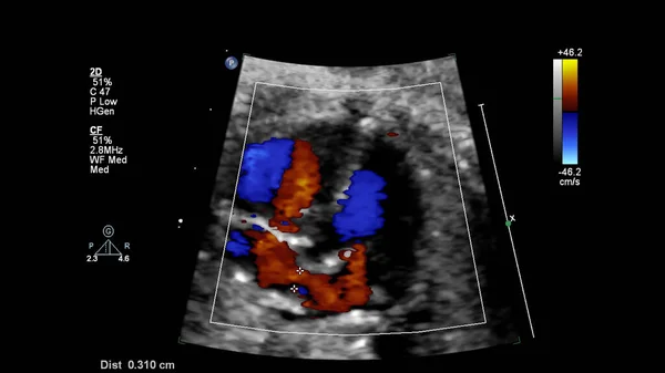 Ecrã Ultrassonográfico Com Ecocardiografia Fetal — Fotografia de Stock