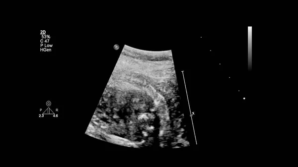 Ecrã Ultrassonográfico Com Ecocardiografia Fetal — Fotografia de Stock