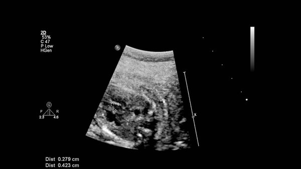 УЗИ с эхокардиографией плода
